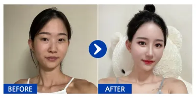 [カンナムオンニ] 目の再手術、目の下の脂肪再配置、鼻、輪郭2点（頬骨、エラ）、胸（モティバ）、脂肪移植（額、前頬） / 1ヶ月目 / ニックネーム：デュドゥデュドゥ