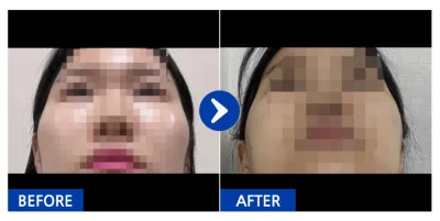 [カンナムオンニ] 輪郭整形(頬骨) / 3週目 / ニックネーム: beami