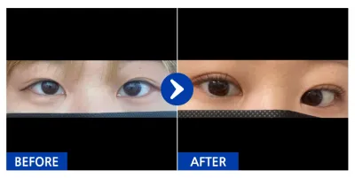 [バビトーク] 自然癒着(二重) / 1ヶ月目 / ニックネーム: 堂山美女