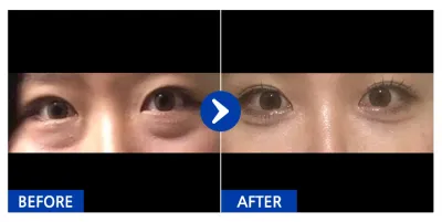 [カンナムオンニ] 目の下の脂肪再配置 / 1ヶ月目 / ニックネーム: スイン