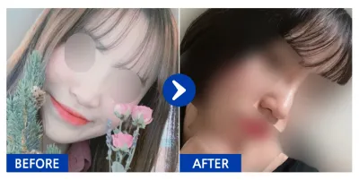 [カンナムオンニ] 鼻整形 1ヶ月目 / ニックネーム : v1nnn