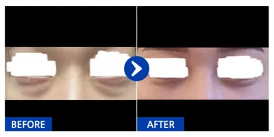 [カンナムオンニ] 目の下の脂肪再配置 1ヶ月目 / ニックネーム：iil1ili