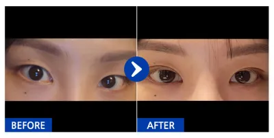 [カンナムオンニ] 自然癒着（二重）1ヶ月目 / ニックネーム：キラー練習生