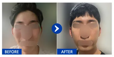 [カンナムオンニ] 頬骨 1ヶ月目 / ニックネーム : firnrb