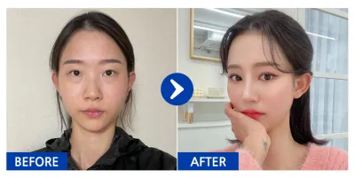 [バビトーク] 目の再手術、目の下の脂肪再配置、鼻、輪郭2点(頬骨、エラ)、胸(モティバ)、脂肪移植(額、前頬) / 3ヶ月目 / ニックネーム: デュデュデュジュジュ