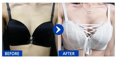 [バビトーク] 豊胸（モティバ 350cc）4ヶ月目 / ニックネーム：綺麗になって