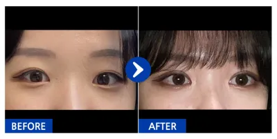 [カンナムオンニ] 二重 1ヶ月目 / ニックネーム：プチウンドン