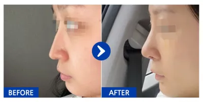 [カンナムオンニ] 鼻整形1週目 / ニックネーム：プィンプィン