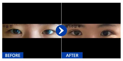 [カンナムオンニ] 二重(埋没法) 1週目 / ニックネーム：ドゥドゥッタダ