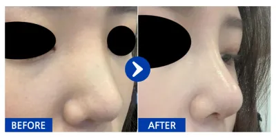 [バビトーク] 鼻整形1ヶ月目/ ニックネーム:ユンイナ