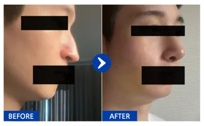 [バビトーク] 鼻整形 1ヶ月目/ ニックネーム: 여우9Kcqw