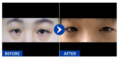 [カンナムオンニ] 目の下の脂肪再配置 / 1ヶ月目 / ニックネーム : yykkyyk