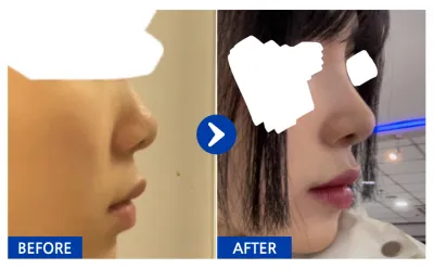 [バビトーク] 鼻整形 1ヶ月目/ ニックネーム:ココモン