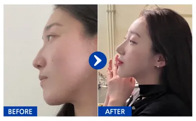 [バビトーク] 鼻整形1年目/ ニックネーム:atmospe