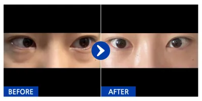 [カンナムオンニ] 目の下の脂肪再配置 / 1ヶ月目 / ニックネーム：castle030