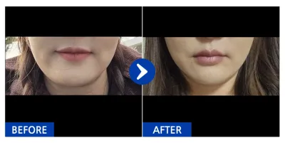 [カンナムオンニ] 糸リフト 1ヶ月目 / ニックネーム：イ・ミソン