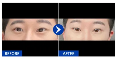 [カンナムオンニ] 目の下の脂肪再配置 / 1ヶ月目 / ニックネーム：ジャンジャン59