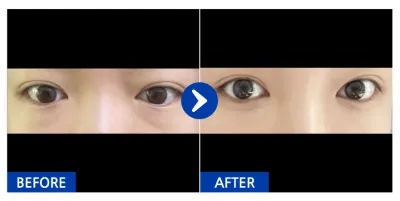 [カンナムオンニ] 目の下の脂肪再配置 / 1ヶ月目 / ニックネーム：ハイッオ