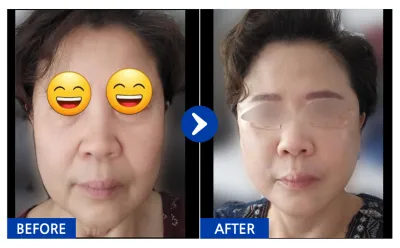 [カンナムオンニ] 糸リフト 1ヶ月目 / ニックネーム：ヨプキトケンイ