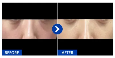 [カンナムオンニ] 目の下の脂肪再配置 / 1ヶ月目 / ニックネーム：ラーメンキンパトッポギ