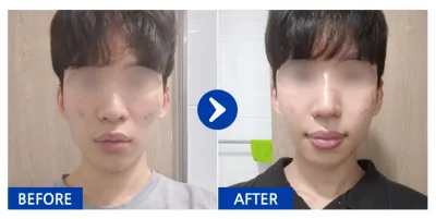 [カンナムオンニ] エラ、頬骨、鼻 / 1ヶ月目 / ニックネーム：chgvv