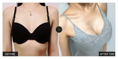 [カンナムオンニ 口コミ] 豊胸手術 10ヶ月目 / ニックネーム：クマアアアン