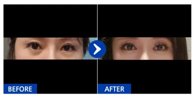 [カンナムオンニ] 目の下の脂肪移植 / 3週目 / ニックネーム：流れるままに〜