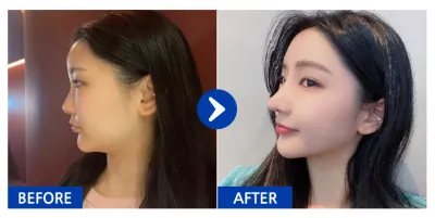 [カンナムオンニ 口コミ] 鼻整形 / 1ヶ月目 / ニックネーム：ニンイククダン