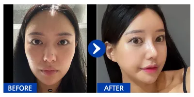 [カンナムオンニ 口コミ] 輪郭3点(頬骨、顎先、エラ)、鼻整形 / 3週目 / ニックネーム：パク・テンテン