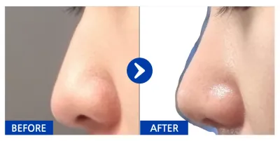 [カンナムオンニ] 鼻 / 1ヶ月目 / ニックネーム : nacola