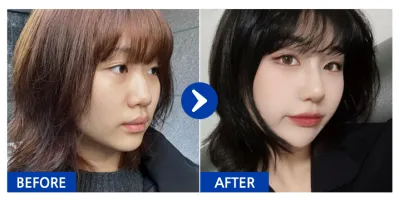 [バビトーク 口コミ] 鼻整形 / 1週目 / ニックネーム：ナナナナナナンニ