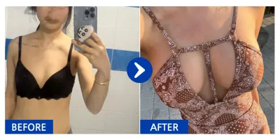 [バビトーク レポ] 豊胸（メンタースムース）/ 3ヶ月目 / ニックネーム：黒い子猫k