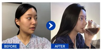 [バビトーク] 鼻整形、輪郭3点(頬骨・エラ・顎先) / 3ヶ月目 / ニックネーム：パク・テンテン