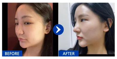 [バビトーク] 鼻整形 / 2週目 / ニックネーム：イッポイッピュ2