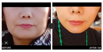 [カンナムオンニ 口コミ] ミニ切開リフト / 1ヶ月目 / ニックネーム：スマイル(ミンギョン)