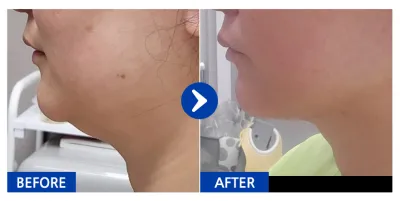 [カンナムオンニ] 脂肪吸引 / 1回目 / ニックネーム:ソジュンサランママ