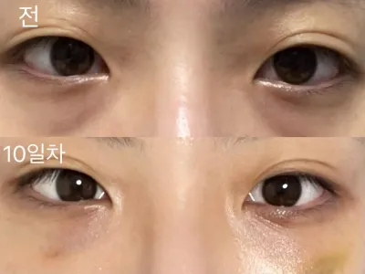 [カンナムオンニ] 目の下の脂肪再配置 / 10日目 / ニックネーム : suntree
