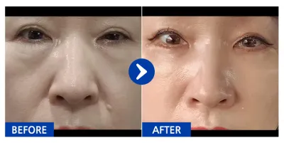 [カンナムオンニ] 下眼瞼 + 脂肪移植 / 1ヶ月目 / ニックネーム：サンスヒャン