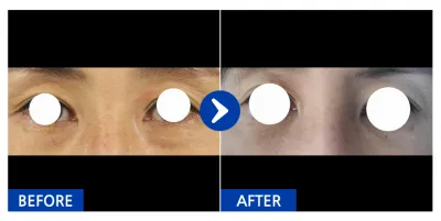 [カンナムオンニ] 目の下の脂肪再配置 / 1ヶ月目 / ニックネーム：チャ・ドゥリの太もも