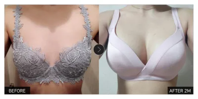 [カンナムオンニ 口コミ] 豊胸整形 2ヶ月目 / ニックネーム：ビティン