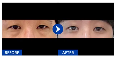 [カンナムオンニ] 目の下の脂肪再配置 / 1ヶ月目 / ニックネーム：ペンベリー