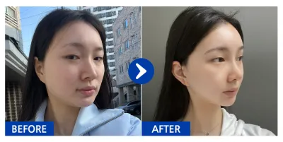 [カンナムオンニ] 鼻整形、輪郭2点(頬骨、エラ) / 1ヶ月目 / ニックネーム：コアリア