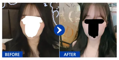 [カンナムオンニ] 頬骨3ヶ月目 / ニックネーム：左右非対称の目が悪い;