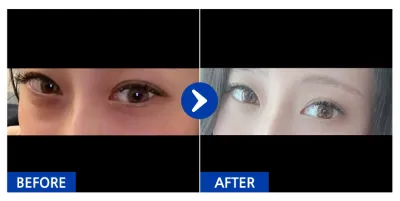 [カンナムオンニ] 目の下の脂肪再配置 / 1ヶ月目 / ニックネーム：モンドゥンイヌナ