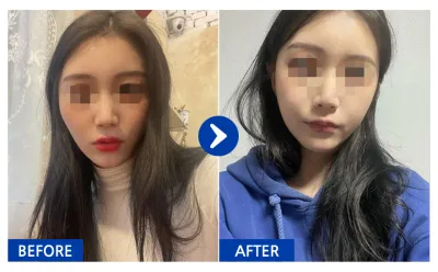 [バビトーク] 顔面輪郭 / 1ヶ月目 / ニックネーム：ボルウムダル