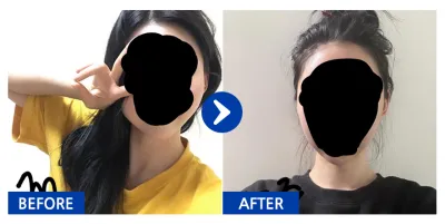 [カンナムオンニ] 頬骨、エラ 1ヶ月目 / ニックネーム：アロラララララン