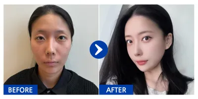 [バビトーク] 輪郭3点、目つき矯正、二重切開、目の下の脂肪再配置、脂肪移植(頬、額) / 1ヶ月目 / ニックネーム: ゲンジY8tvn