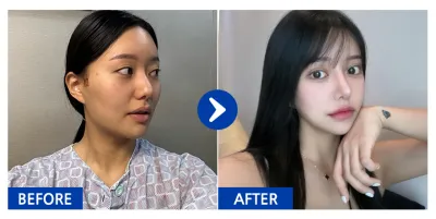 [バビトーク] 輪郭3点、鼻整形 / 6ヶ月目 / ニックネーム: パク・テンテン