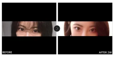 [バビトク 口コミ] 目の下の脂肪再配置 2週目 / ニックネーム：メイラ