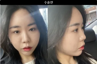 [カンナムオンニの口コミ] 鼻整形1ヶ月目 / ニックネーム：ドゥルルルッドゥルルルッ